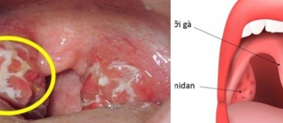 Here’s What You Need to Know About Tonsil Stones